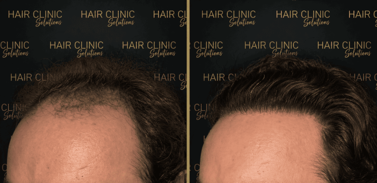 antes y despues (1)