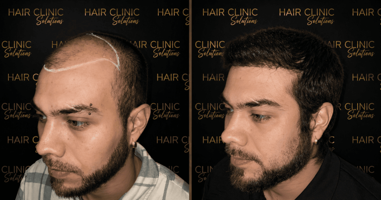 antes y despues (5)