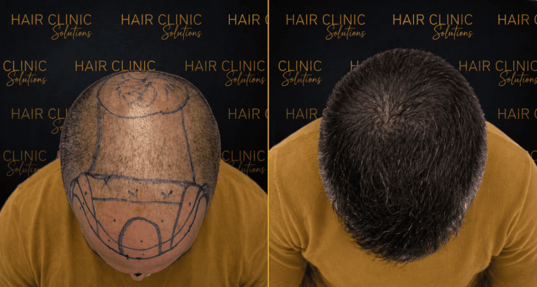 antes y despues (7)